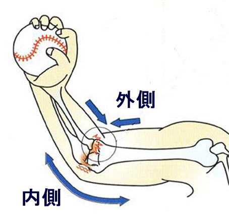 野球肘